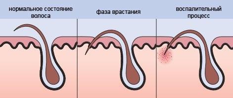 Вросшие волосы на ногах лечение в домашних условиях