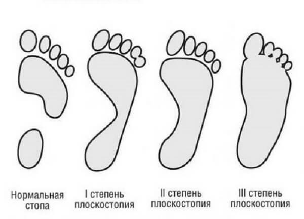 Как определить плоскостопие в домашних условиях