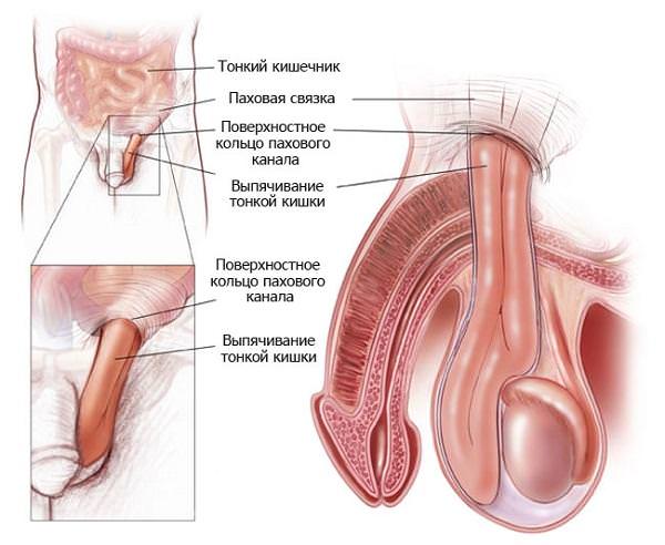 Скользящая паховая грыжа