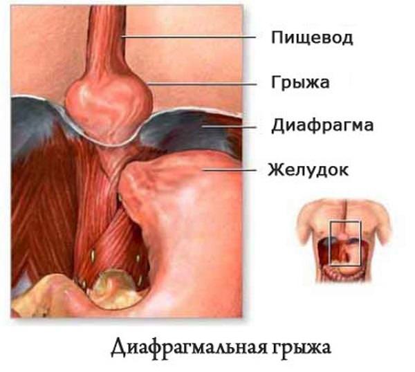 Диафрагмальная грыжа пищевода 