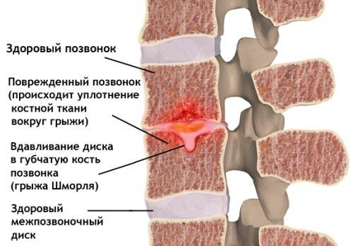 Эффективно лечим грыжу Шморля 