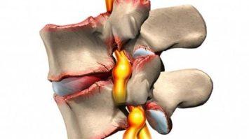 Грыжа Шморля: виды, симптомы, причины и лечение