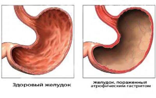 Атрофический гастрит причины появления