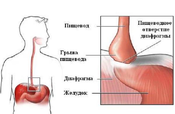 Грыжа пищевода сипмтомы