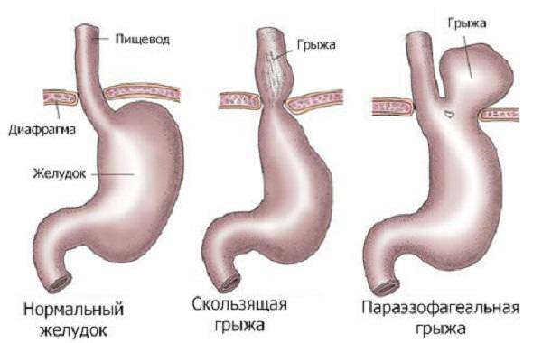 Грыжа пищевода признаки симптомы