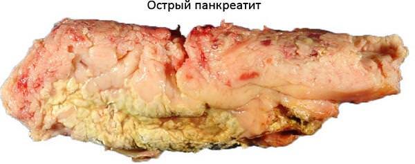 Чем отличается острый панкреатит от хронического