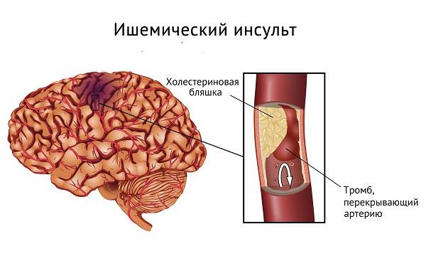 Ишемический инсульт