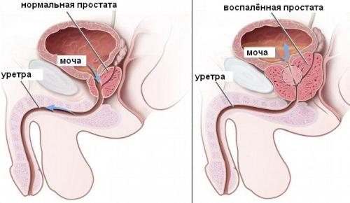 Лечим простатит простыми способами 