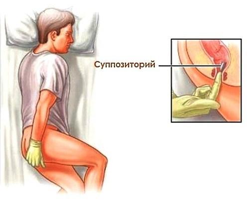 Введение свечи при геморрое 