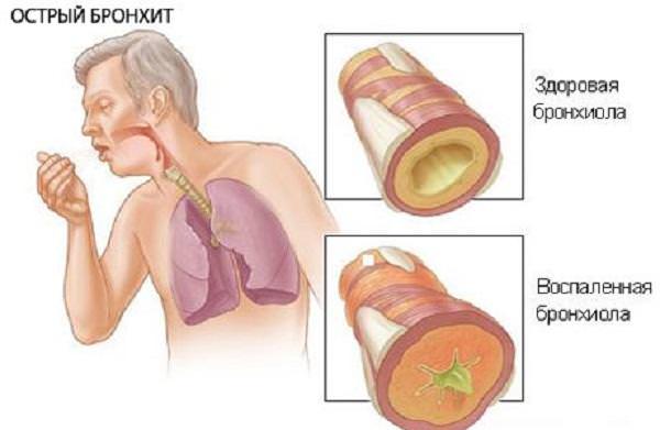 Острый бронхит симптомы 