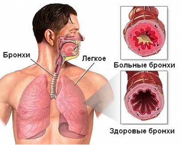 Бронхит лечение