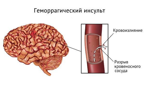 Геморрагический инсульт - что это