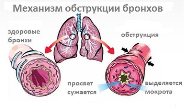 Обструктивный бронхит виды