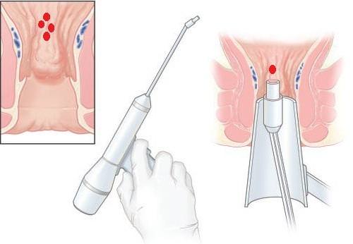 Инфракрасное излучения для лечения геморроя 