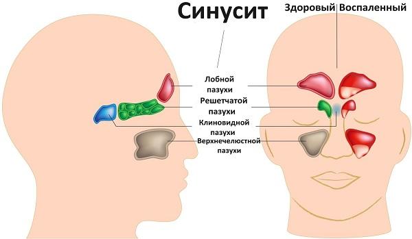 Как отличить синусит от гайморита