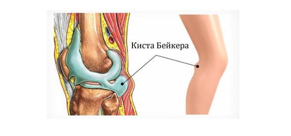 Киста Байкера