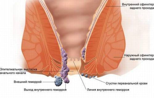 Наружный геморрой у мужчин 