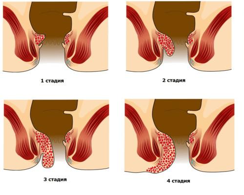 Стадии геморроя у мужчин 