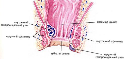 Внутренний геморрой у мужчин 