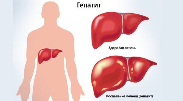 Аутоммонный гепатит причины 