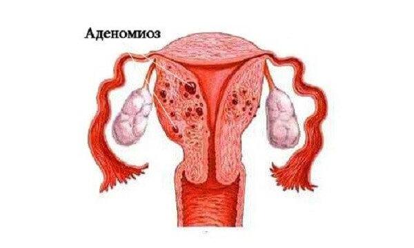 Что такое аденомиоз