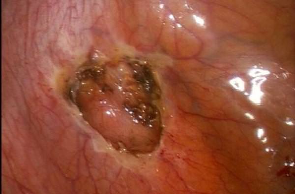  Эндометриоз шейки матки