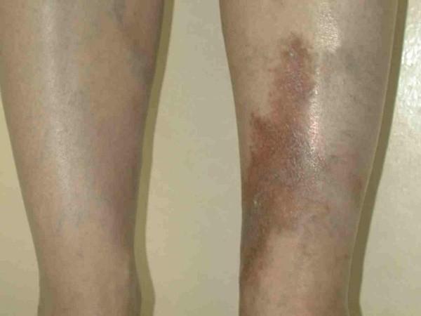 Фото трофических язв 