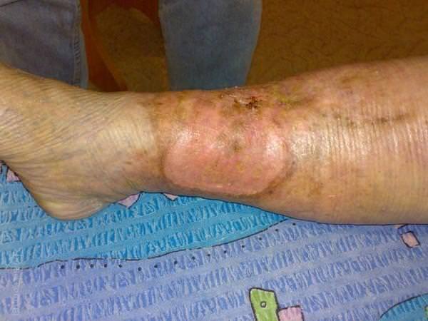 Фото заболевания 