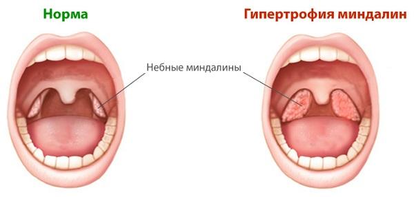 Функции миндалин