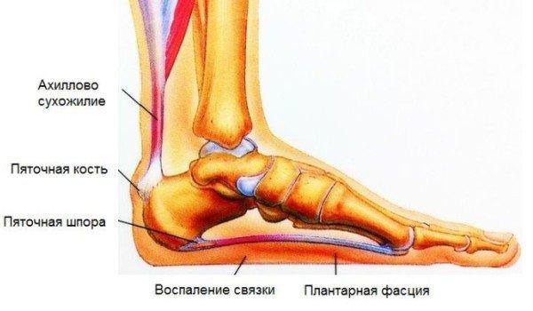 Избавляемся от бурсита пятки 