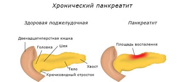 Можно ли арбуз при хроническом панкреатите