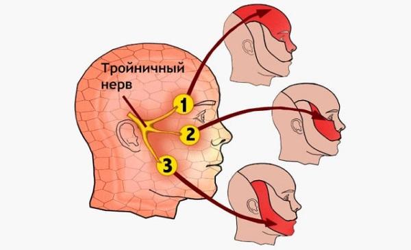 Невралгия тройничного нерва