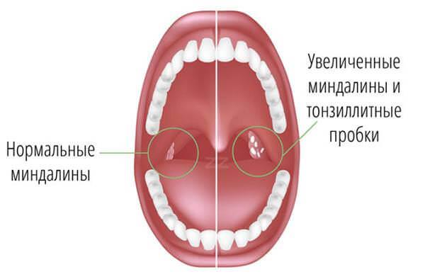 Причины развития острого тонзиллита