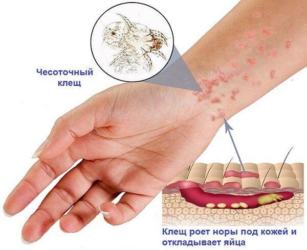 Признаки возникновения чесотки