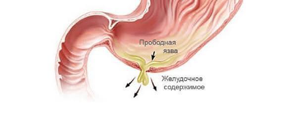 Прободная язва желудка причины возникновения