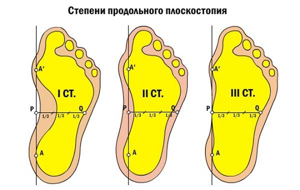 С каким плоскостопием не берут в армию