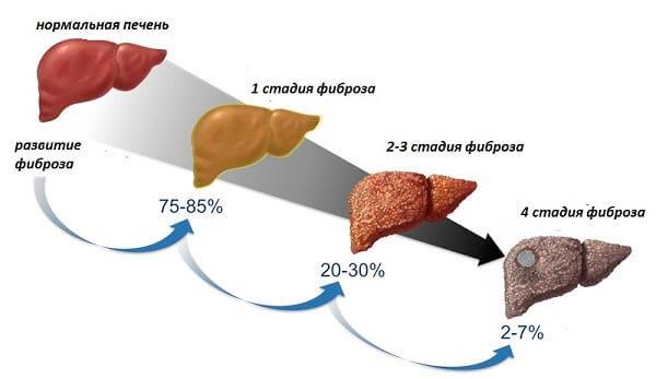 Степени цирроза печени