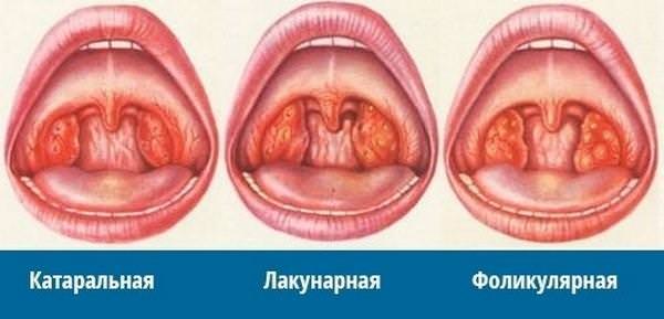 Виды поражения миндалин при остром тонзиллите