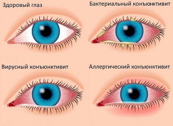 Виды заболевания