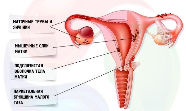 Внутренний эндометриоз, что это такое