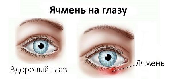 yachmen-pervye-simptomy-zabolevaniya