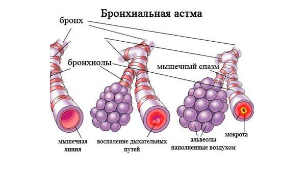 Астма у взрослых