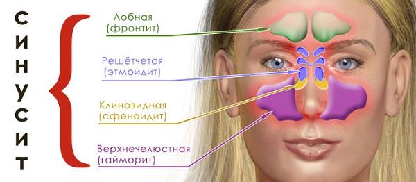 Что такое синусит