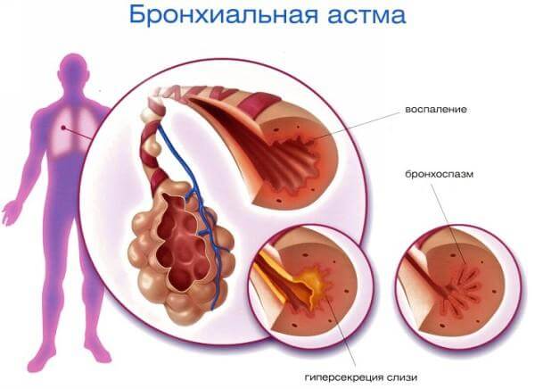 Отличие бронхиальной астмы от сердечной