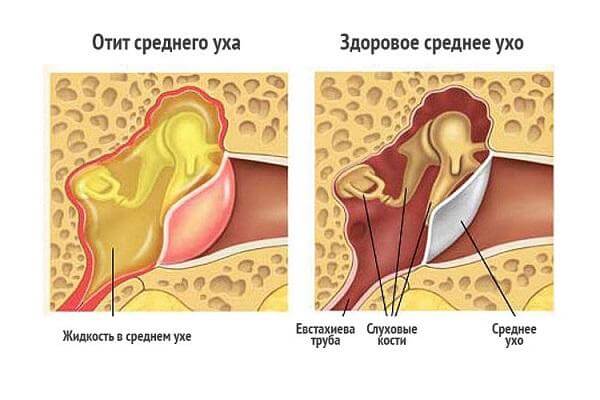 Виды отита