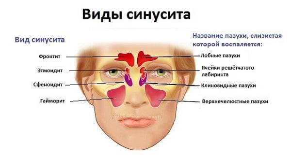 Виды синуситов