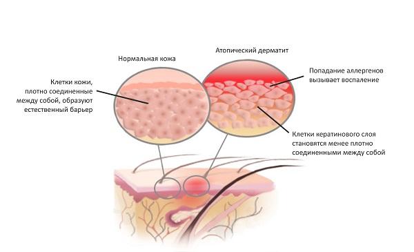 Атопический дерматит