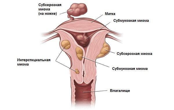 Формы миомы матки 