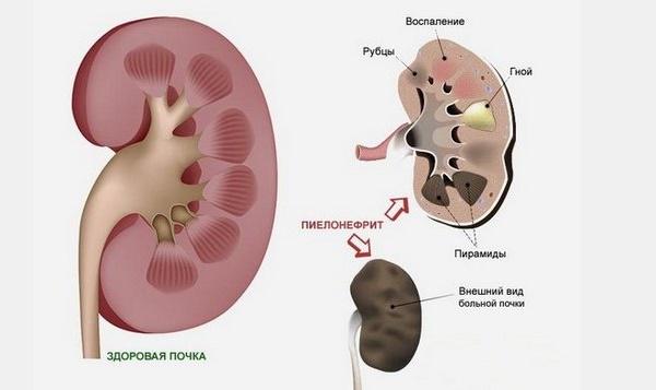 Гестационный пиелонефрит