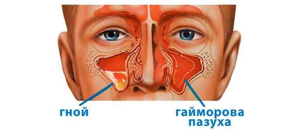 Гнойный одонтогенный гайморит